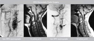 Αγγειακές Δυσπλασίες Αγγειακές Δυσπλασίες