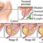 Καρκίνος Προστάτη Καρκίνος Προστάτη