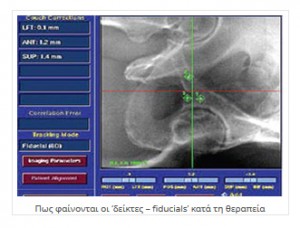 Πλεονεκτήματα CyberKnife® Πλεονεκτήματα CyberKnife®